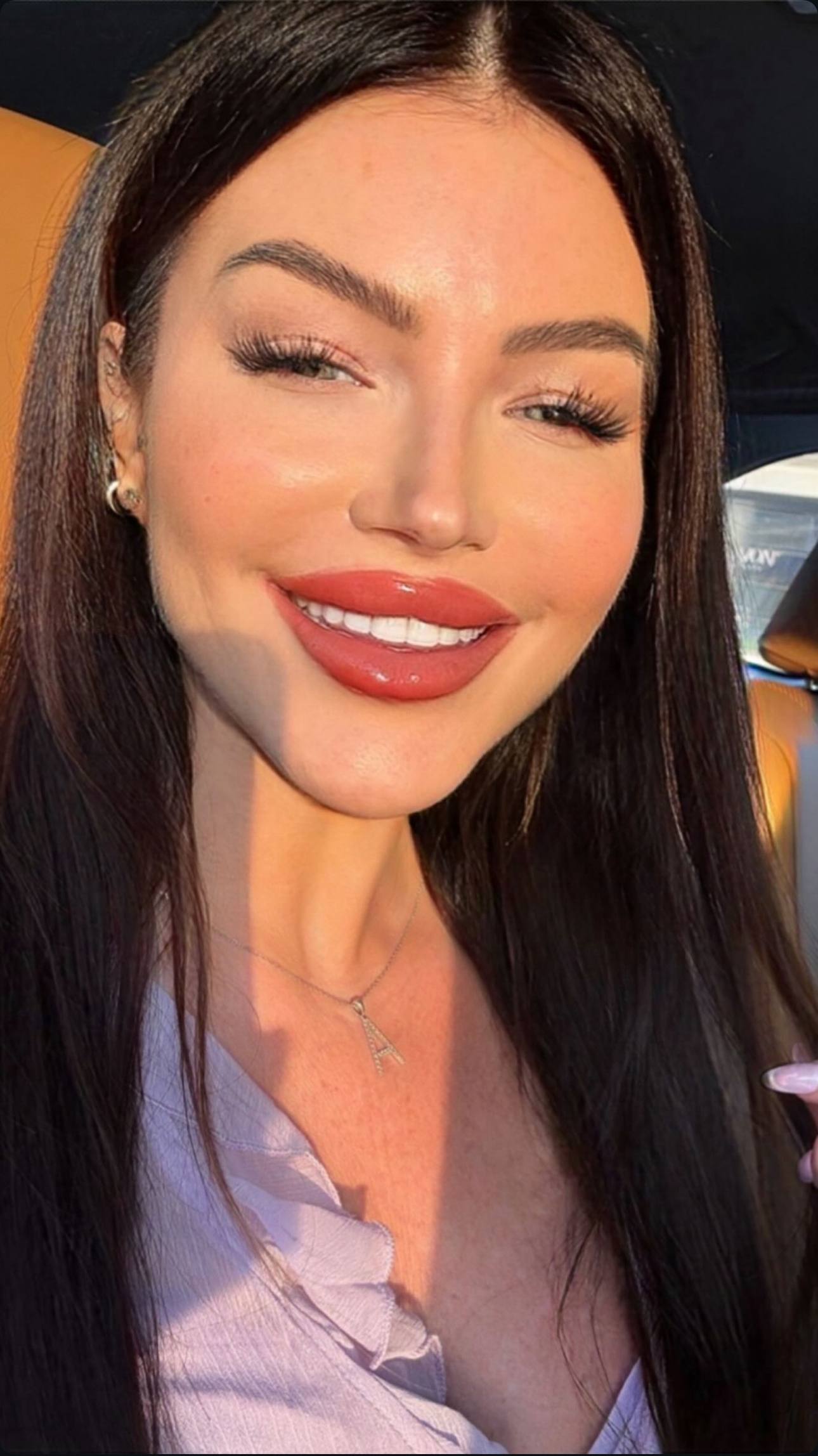 Patient smile after treatment